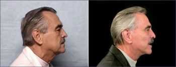 Male Facelift Patient 1