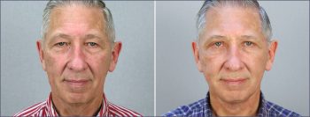 Male Facelift Patient 2
