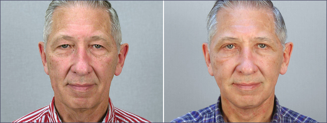 Male Facelift Patient 2
