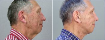 Male Facelift Patient 2