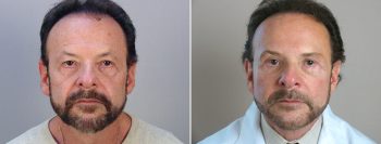 Male Facelift Patient 3