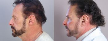 Male Facelift Patient 3