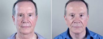 Male Facelift Patient 4