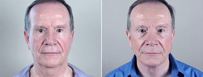 Male Facelift Patient 4