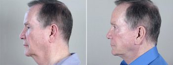 Male Facelift Patient 4