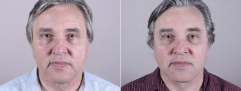 Male Facelift Patient 5