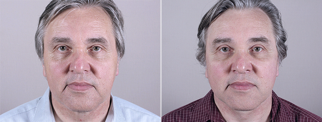 Male Facelift Patient 5