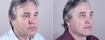 Male Facelift Patient 5