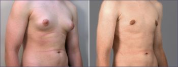 Gynecomastia Reduction Patient 1