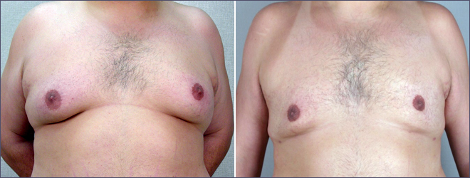 Gynecomastia Reduction Patient 2