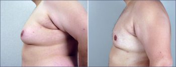 Gynecomastia Reduction Patient 2