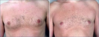 Gynecomastia Reduction Patient 3