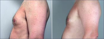 Gynecomastia Reduction Patient 3