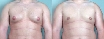 Gynecomastia Reduction Patient 4
