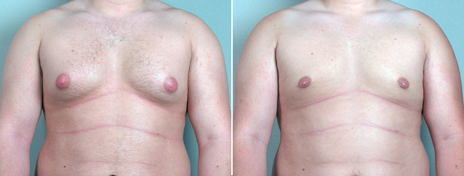 Gynecomastia Reduction Patient 4