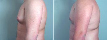 Gynecomastia Reduction Patient 4