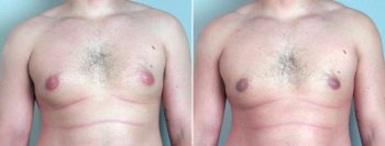 Gynecomastia Reduction Patient 5