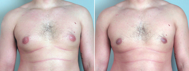 Gynecomastia Reduction Patient 5