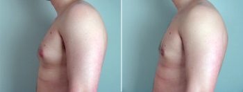 Gynecomastia Reduction Patient 5