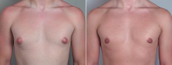 Gynecomastia Reduction Patient 6