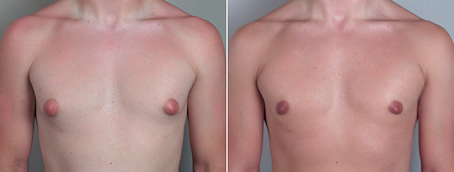 Gynecomastia Reduction Patient 6