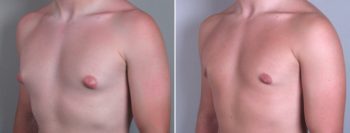 Gynecomastia Reduction Patient 6