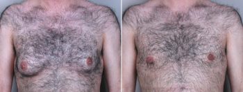 Gynecomastia Reduction Patient 7