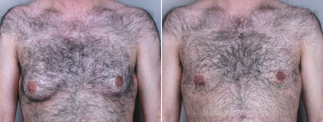 Gynecomastia Reduction Patient 7