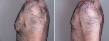 Gynecomastia Reduction Patient 7