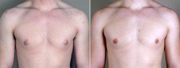 Gynecomastia Reduction Patient 8
