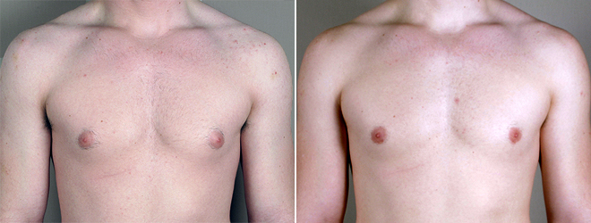 Gynecomastia Reduction Patient 8