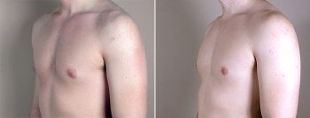 Gynecomastia Reduction Patient 8
