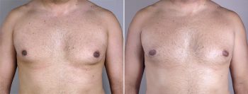 Gynecomastia Reduction Patient 9