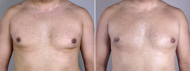 Gynecomastia Reduction Patient 9