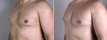 Gynecomastia Reduction Patient 9