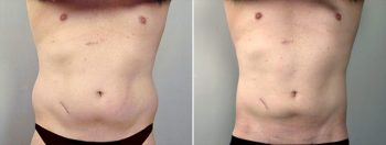 Male Liposuction Patient 1