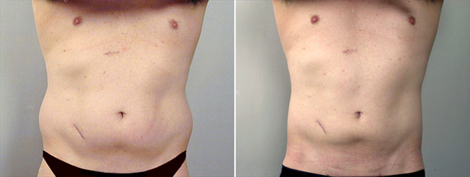 Male Liposuction Patient 1