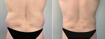 Male Liposuction Patient 1