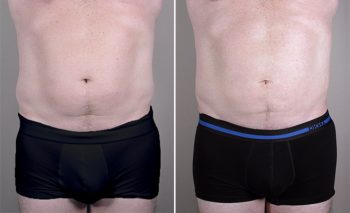 Male Liposuction Patient 5