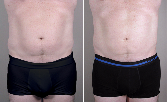 Male Liposuction Patient 5