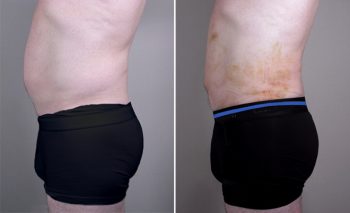 Male Liposuction Patient 5