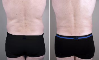 Male Liposuction Patient 5