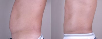 Male Liposuction Patient 6