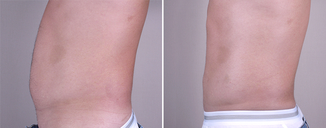 Male Liposuction Patient 6