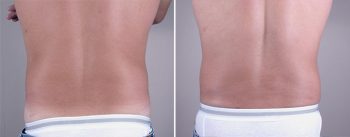 Male Liposuction Patient 6