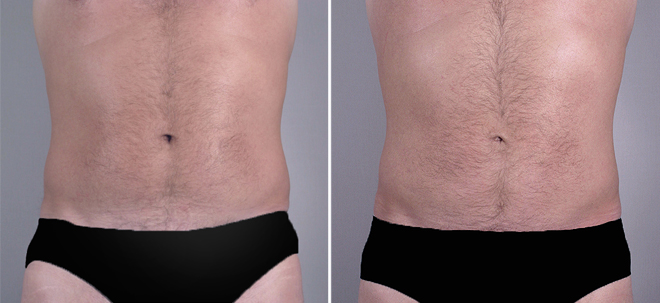 Male Liposuction Patient 8