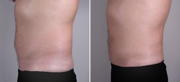 Male Liposuction Patient 8