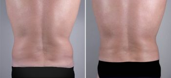 Male Liposuction Patient 8