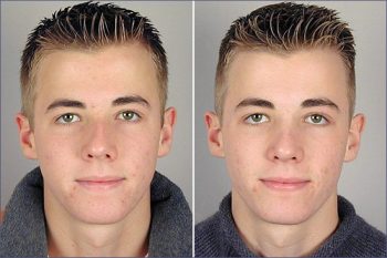 Male Rhinoplasty Patient 1