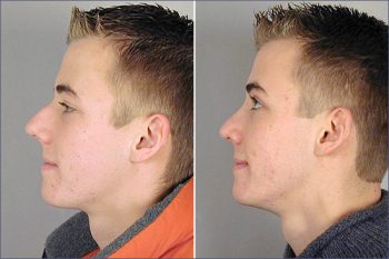 Male Rhinoplasty Patient 1